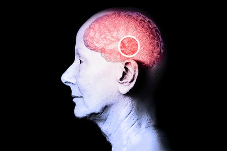 Photo illustration, profile portrait of an older woman in black and white with a colored illustration of a brain overlayed over head and a circled area in the middle above ear