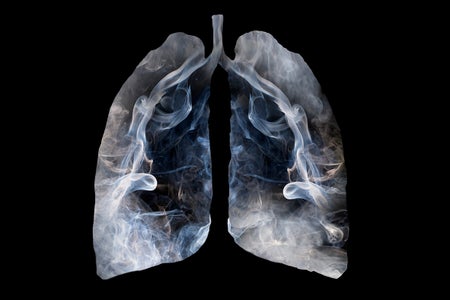 Scan of lungs